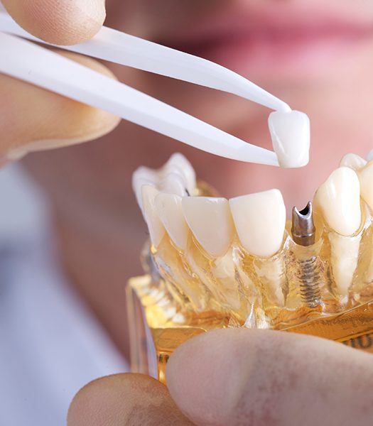 Dentist placing implant on plastic jaw