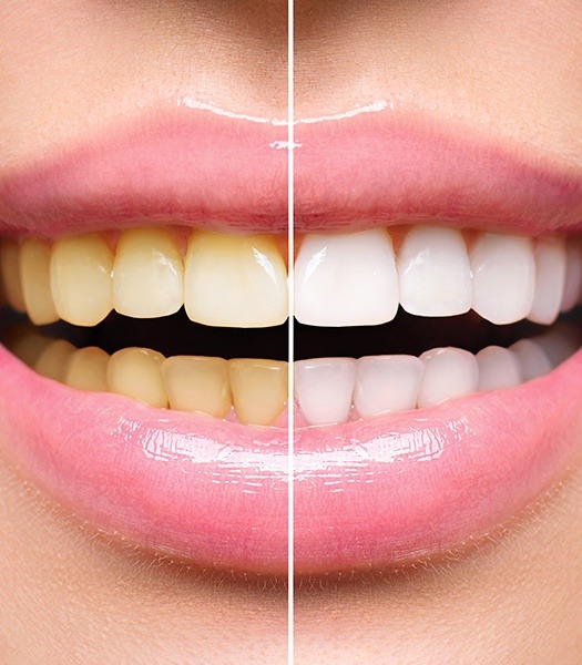 half of smile before and after whitening