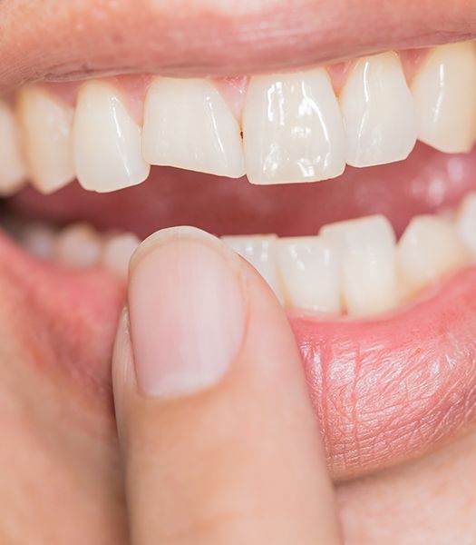 close up of chipped tooth