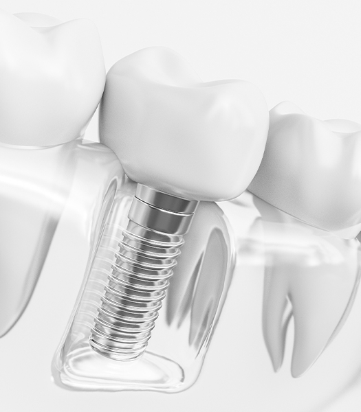 illustration of single implant