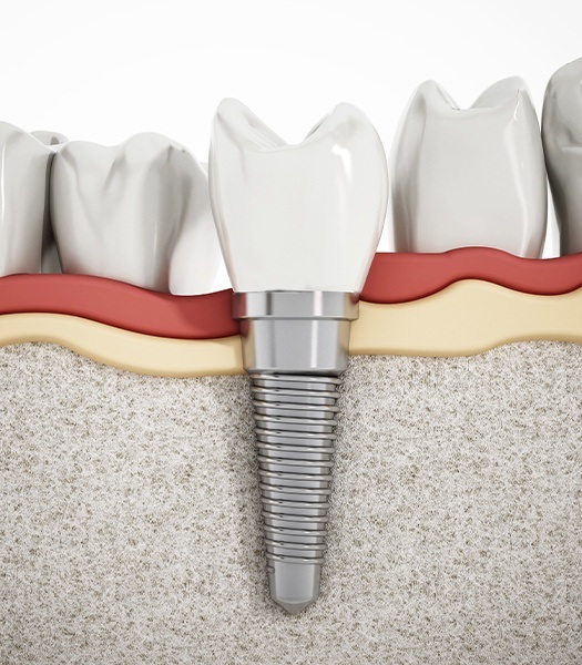 illustration of implant in tooth