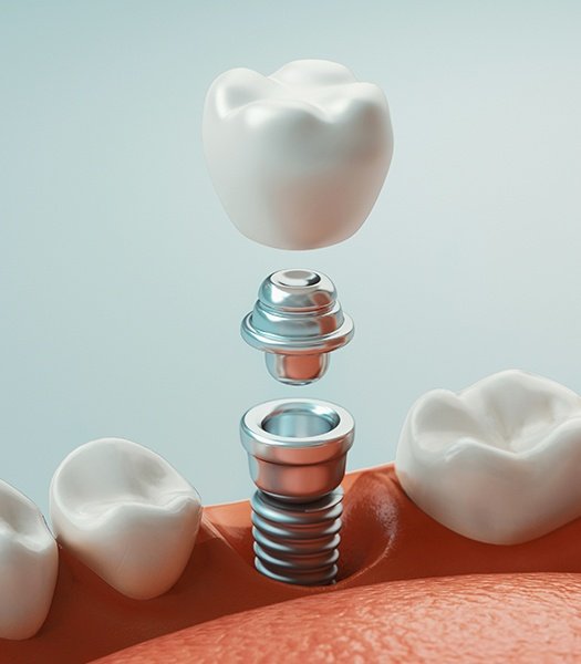 three parts of single tooth implant