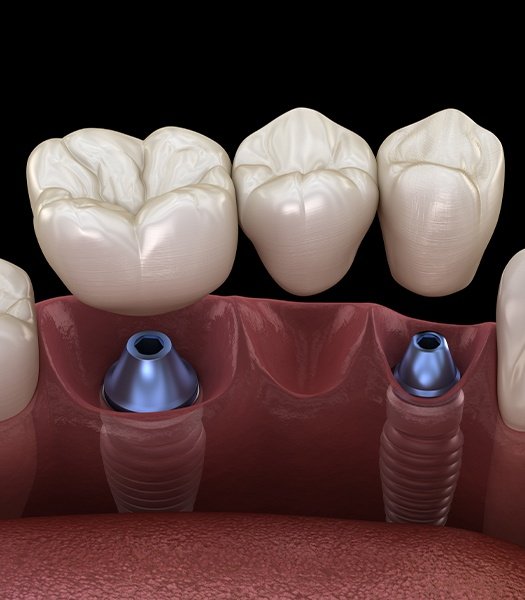 Illustration of multiple implants