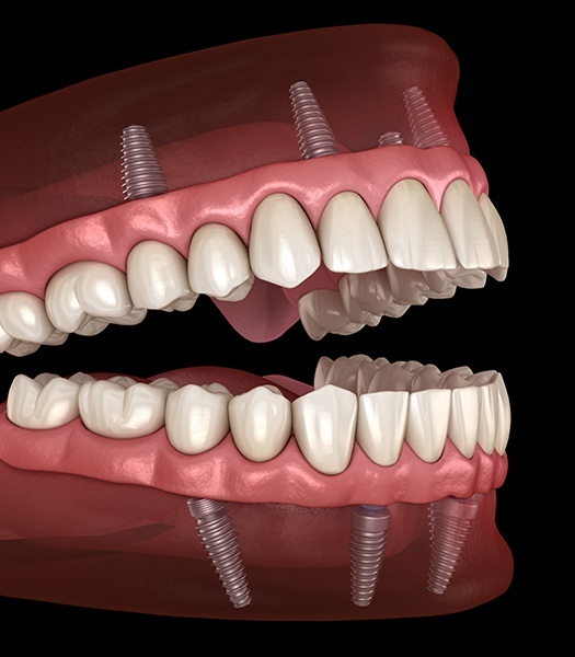 illustration of complete implants