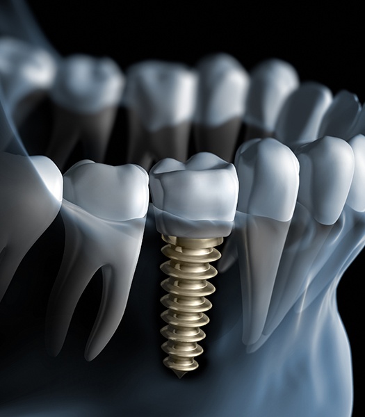 Computer illustration of dental implants