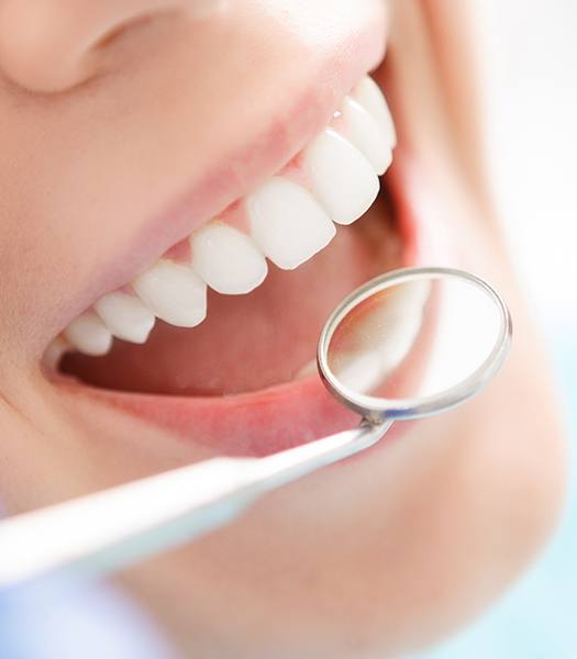 close shot of smile with tooth colored fillings