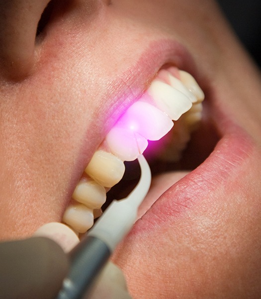 soft tissue laser behind teeth